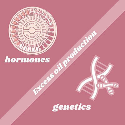Infographic: Hormones, Excess Oil Production, Genetics