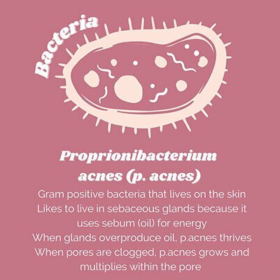 Bacteria infographic - Proprionibacterium acnes (p. acnes). Gram positive bacteria that lives on the skin likes to live in sebaceous glands because it uses sebum (oil) for energy. When glands overproduce oil, p. acnes thrives. When pores are clogged, p. acnes grows and miltiplies within the pore.