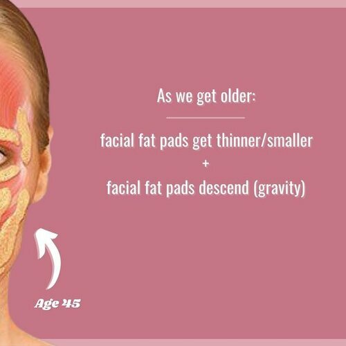 As we get older: Facial fat pads get thinner/smaller + Facial fat pads descend (gravity).