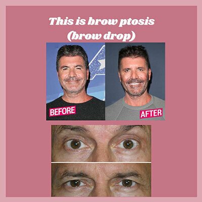 This is brow ptosis (brow drop) graphic of simon cowel