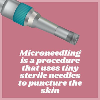Microneedling is a procedure that uses tiny sterile needles to puncture the skin