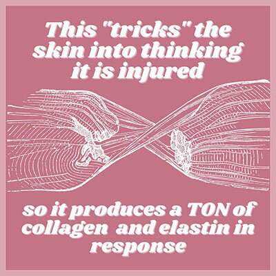 This 'tricks' the skin into thinking it is injured so it produces a TON of collagen and elastin in response.
