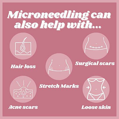 Microneedling can also help with... hair loss, surgical scars, stretch marks, acne scars, loose skin.