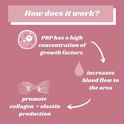 How does it work? - PRP has a high concentration of growth factors, increases blood flow to the area, promotes collagen + elastin production.