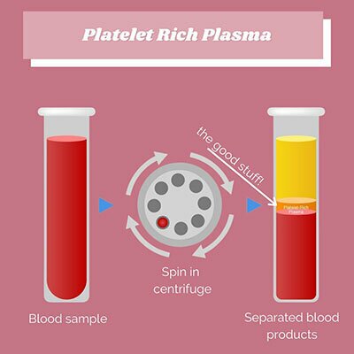 Platelet Rich Plasma infographic