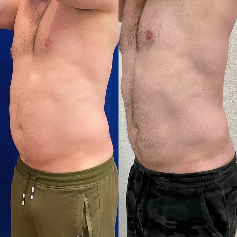 Emsculpt NEO Before & After Image