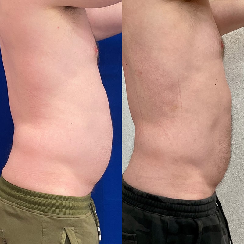 Emsculpt NEO Before & After Image