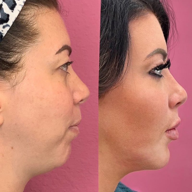 Dermal Fillers Before & After Image