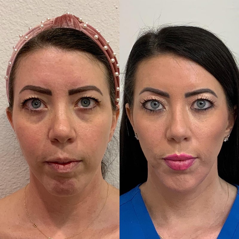 Dermal Fillers Before & After Image