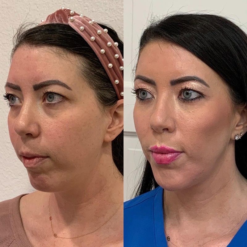 Dermal Fillers Before & After Image