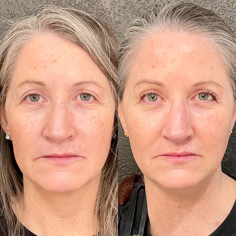 Dermal Fillers Before & After Image