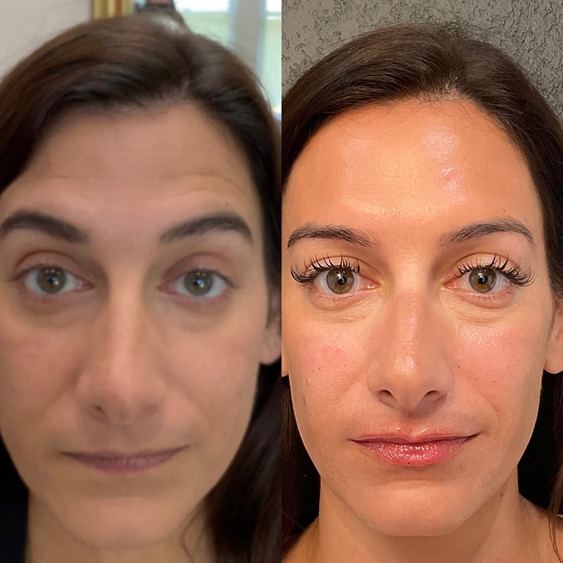 Dermal Fillers Before & After Image