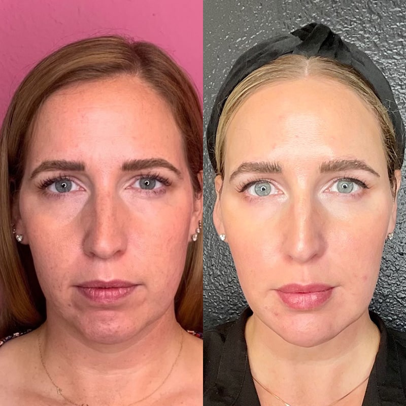 Dermal Fillers Before & After Image