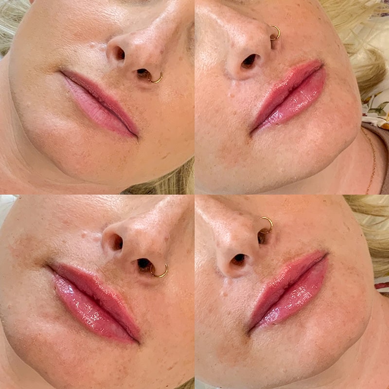 Lip Fillers Before & After Image