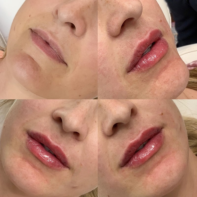 Lip Fillers Before & After Image