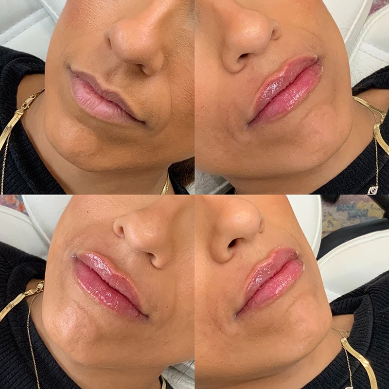 Lip Fillers Before & After Image