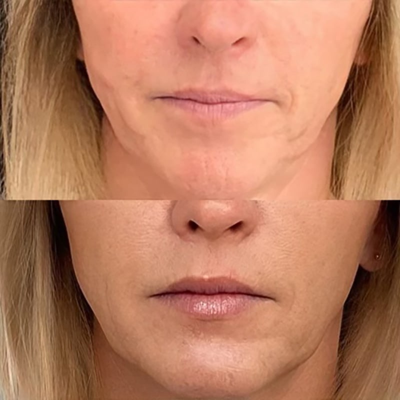 Lip Fillers Before & After Image