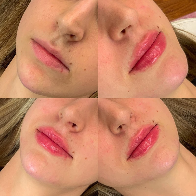 Lip Fillers Before & After Image