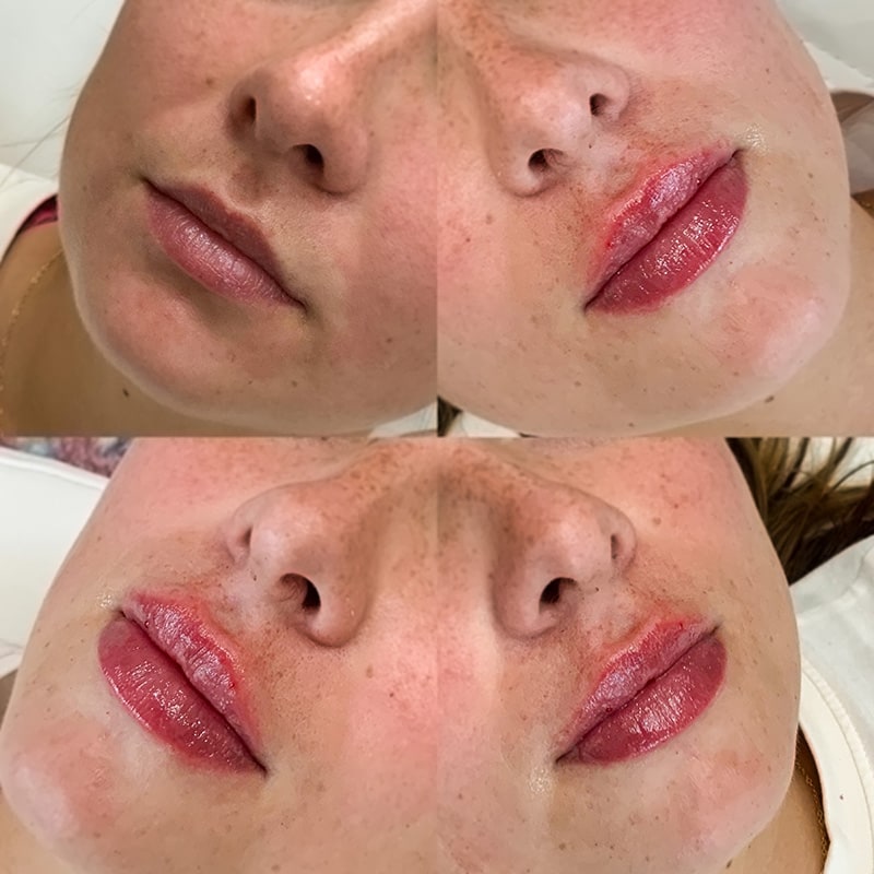 Lip Fillers Before & After Image