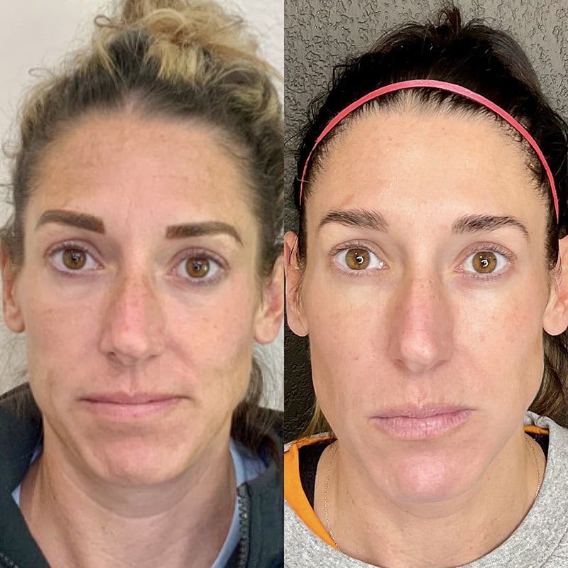 PRP Injections Before & After Image