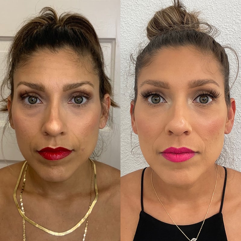 PRP Injections Before & After Image