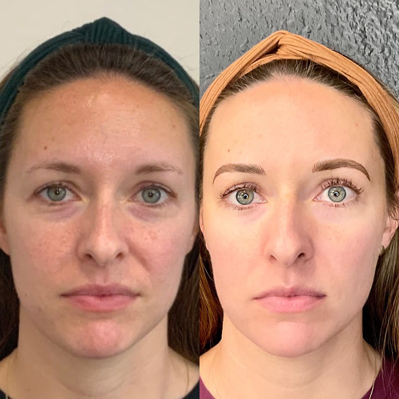 PRP Injections Before & After Image