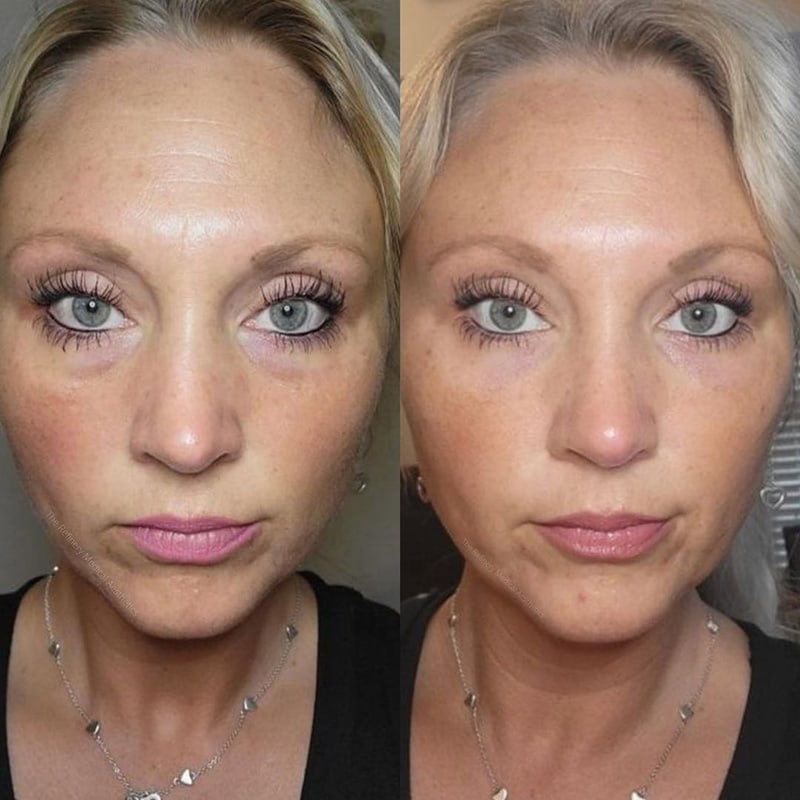 PRP Injections Before & After Image