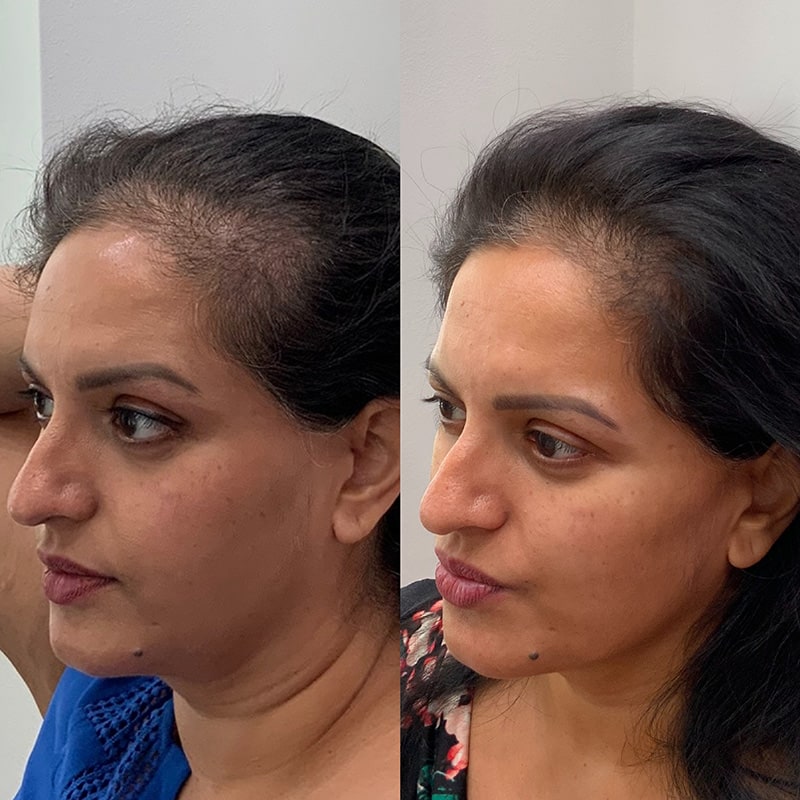 Hair Restoration Before & After Image