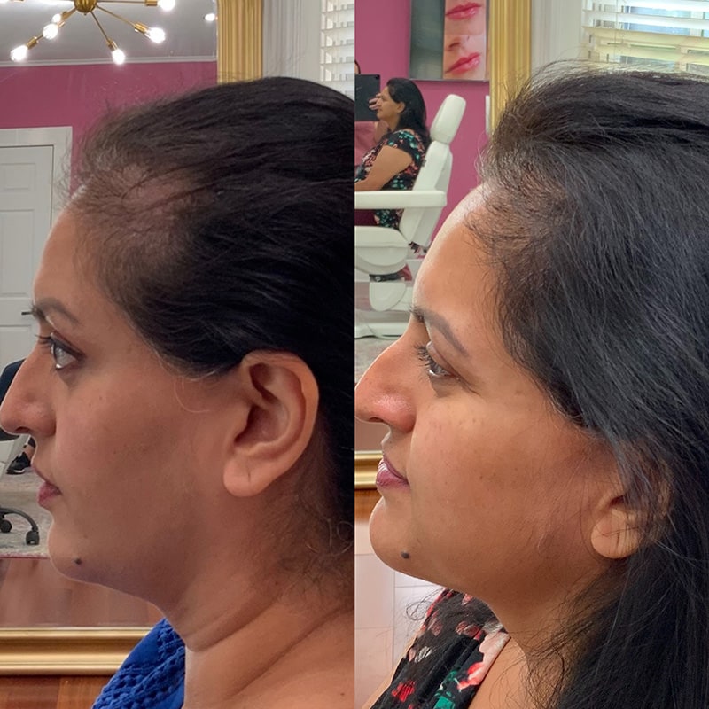 Hair Restoration Before & After Image