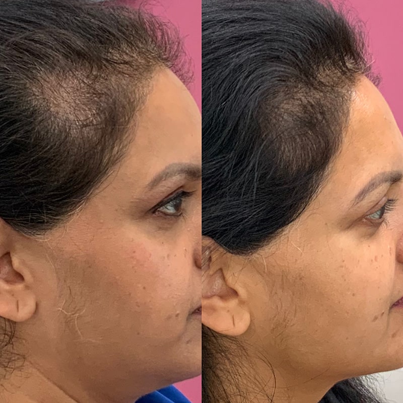 Hair Restoration Before & After Image