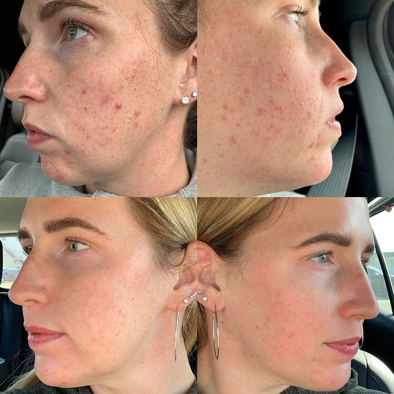 Medical Grade Skincare Before & After Image