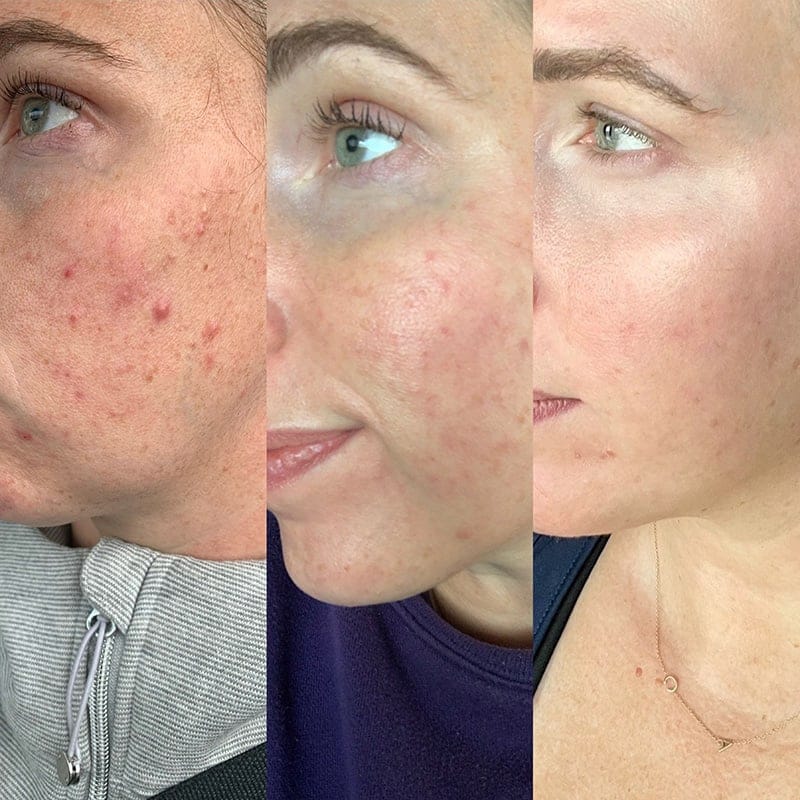 Medical Grade Skincare Before & After Image