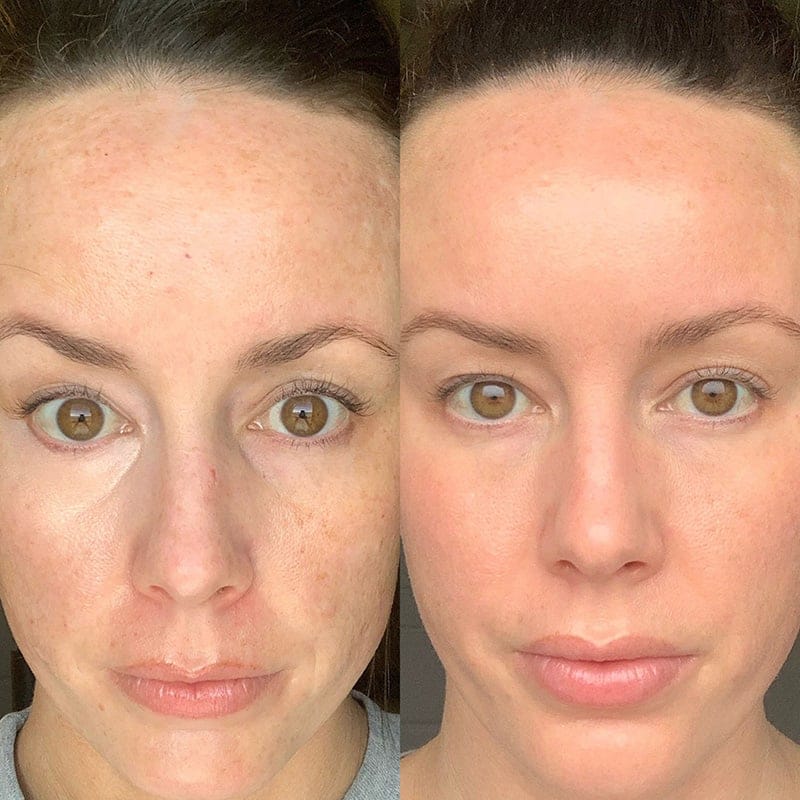 Medical Grade Skincare Before & After Image