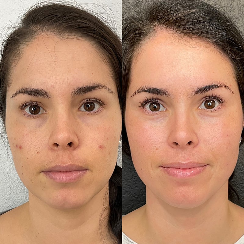 Microneedling Before & After Image