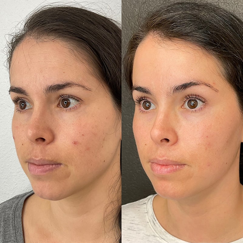 Microneedling Before & After Image