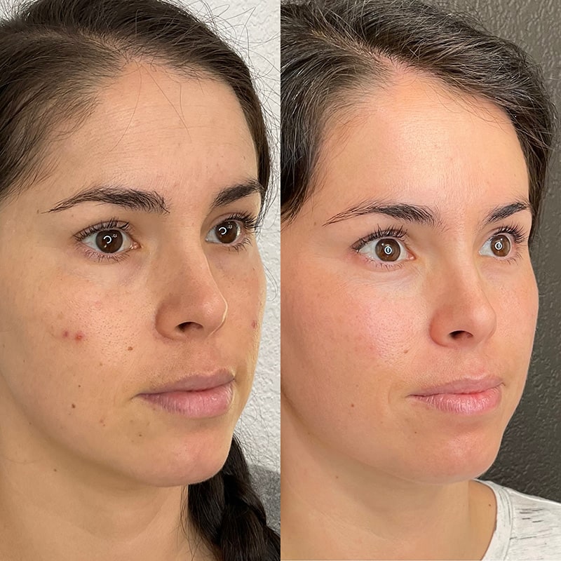 Microneedling Before & After Image