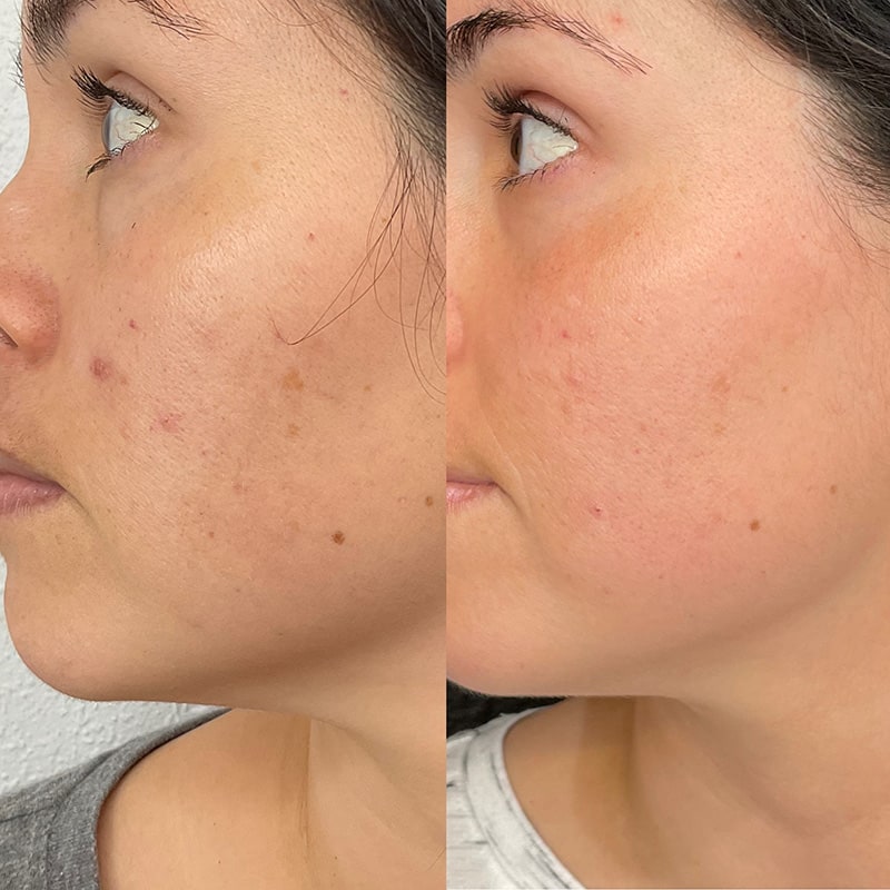 Microneedling Before & After Image