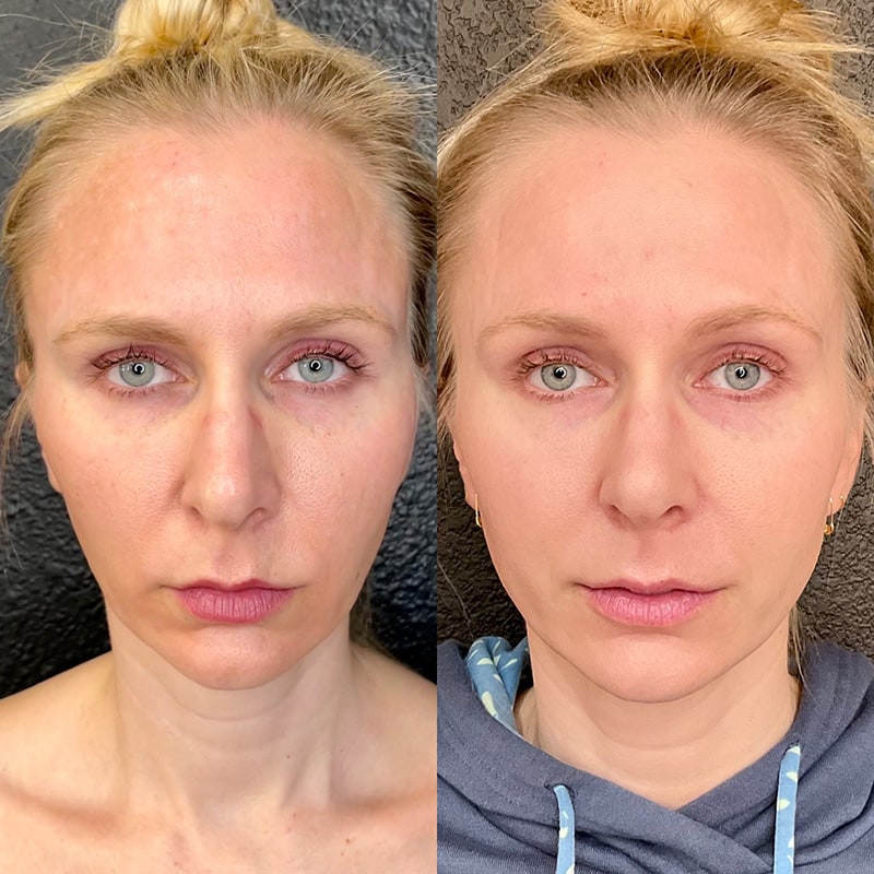 Microneedling Before & After Image