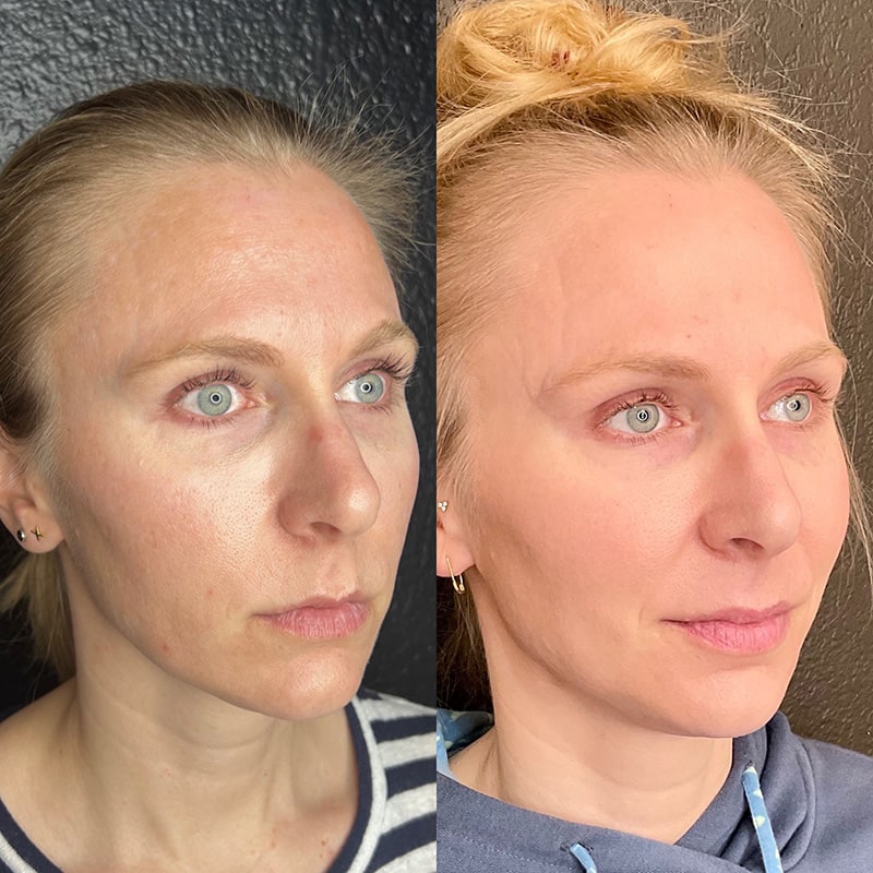 Microneedling Before & After Image