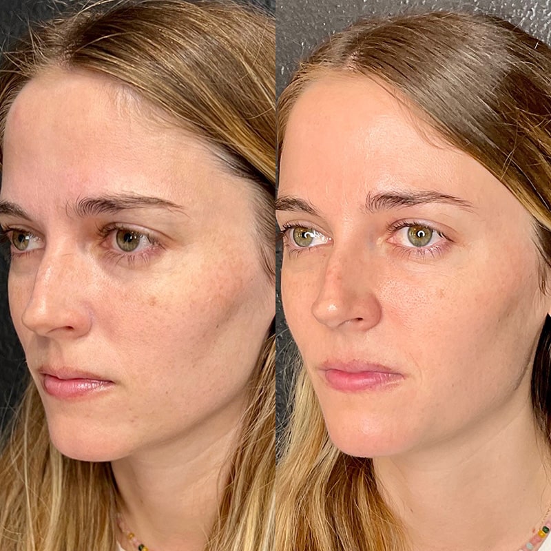 Microneedling Before & After Image